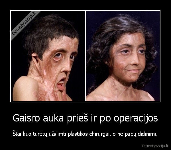 sokiruojanti, nuotrauka,mergaite, po, nudegimo