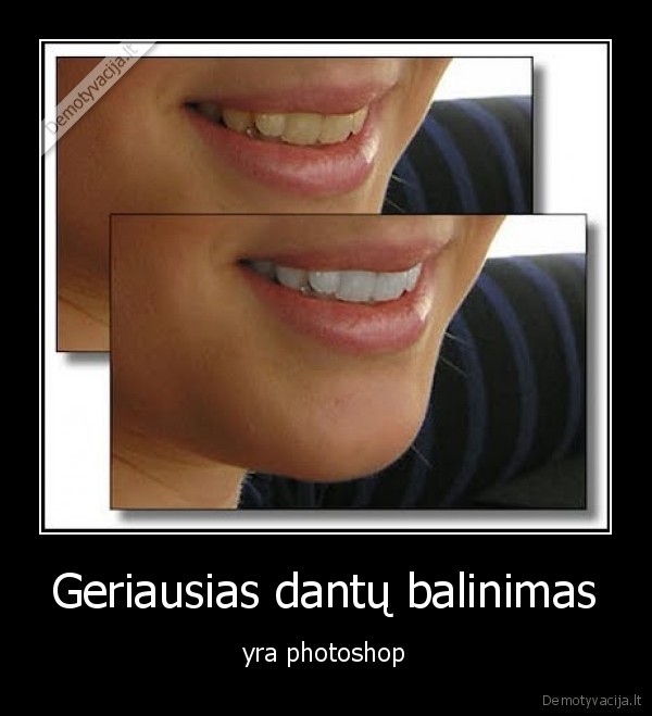 Geriausias dantų balinimas