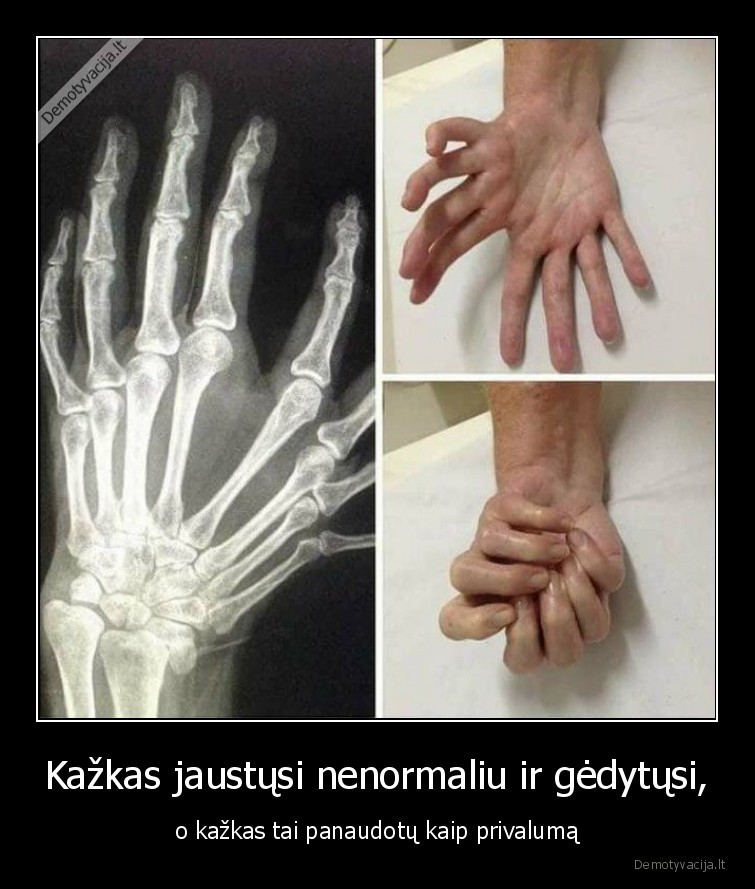 privalumai,geda,nenormaliu,rankos,ranka,pirstai,idomybes,kunas
