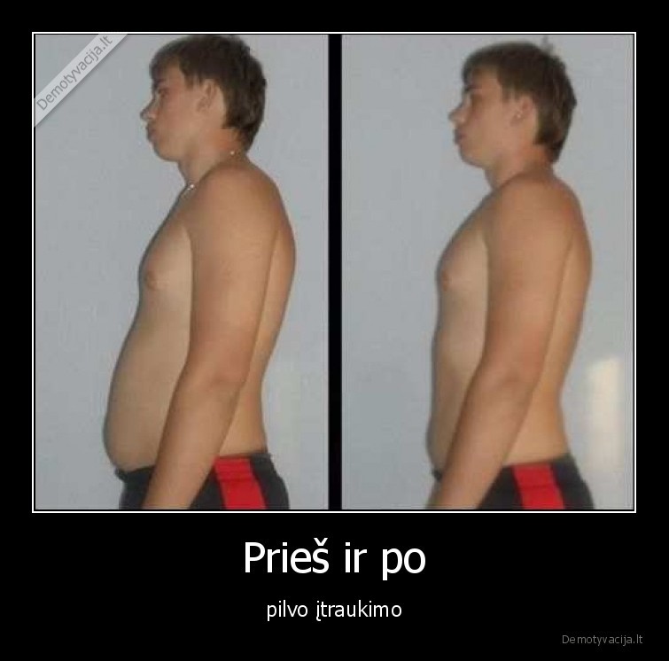 pilvo,itraukimas,pries,po