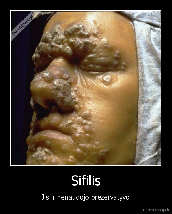 Sifilis
