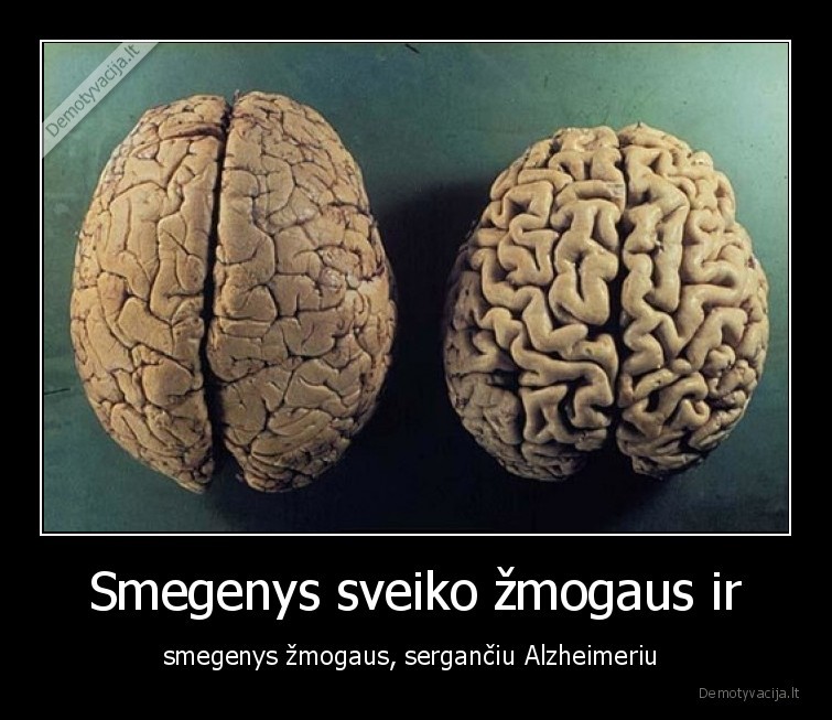 alzheimer,smegenys,sergantis