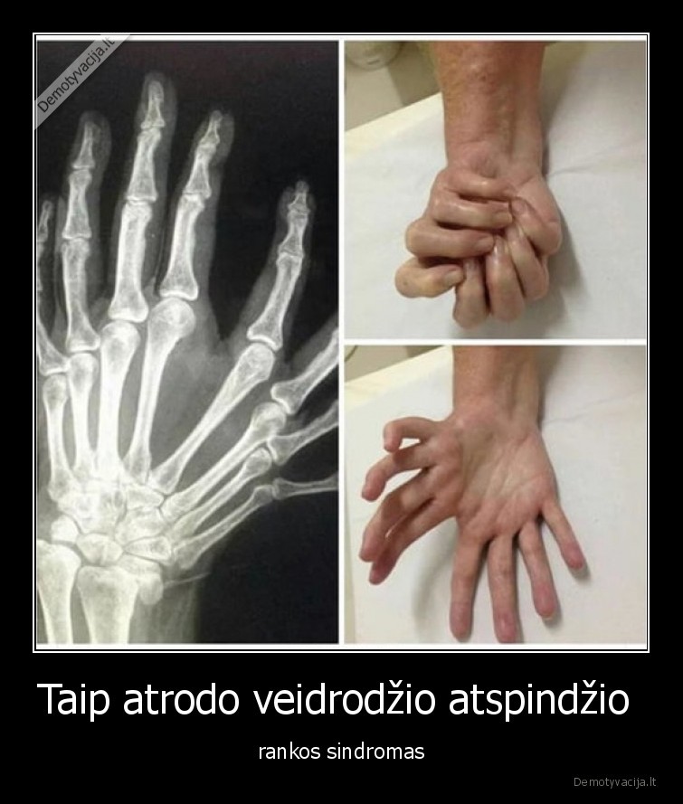 ranka,sindromas,veidrodzio,atspindys