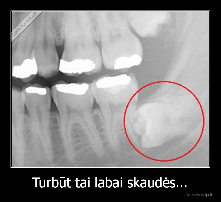 skauda,dantys,operacija,rentgenas