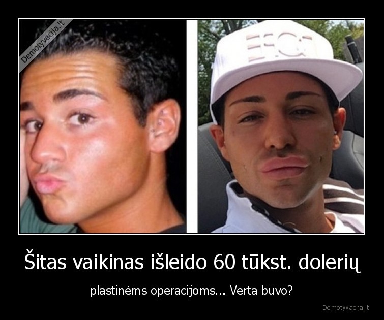 plastines,operacijos,daug,pinigu,isleido,vaikinas