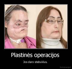 Plastinės operacijos  - Jos daro stebuklus. 