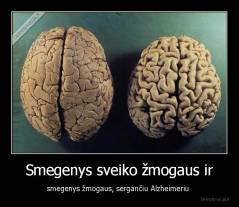 Smegenys sveiko žmogaus ir - smegenys žmogaus, sergančiu Alzheimeriu 